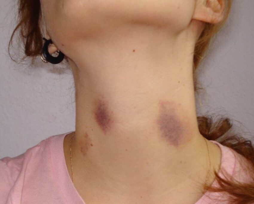 hickey