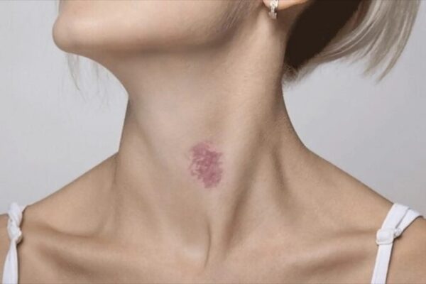 hickey