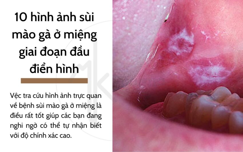 Chẩn Đoán Sùi Mào Gà