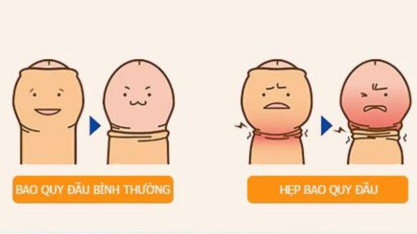 Hẹp Và Bán Hẹp Bao Quy Đầu