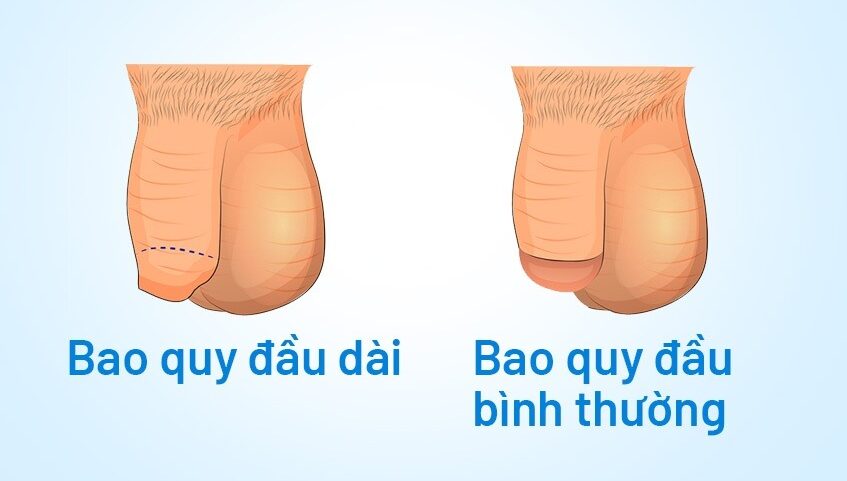 Bao Quy Đầu Dài