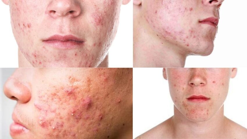 Chăm Sóc Sức Khỏe Hậu Dậy Thì