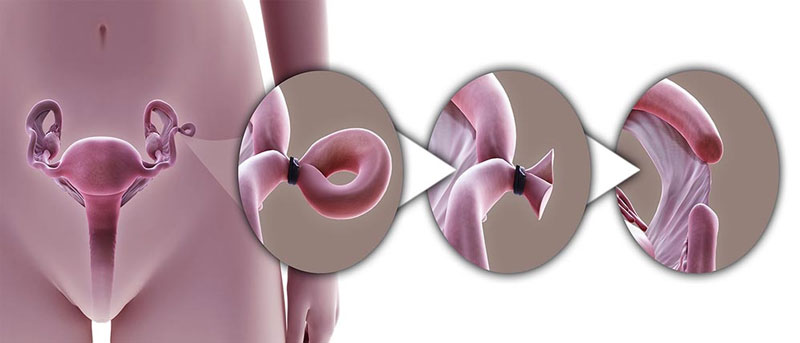 Phụ Nữ Triệt Sản Có Ảnh Hưởng Gì Không