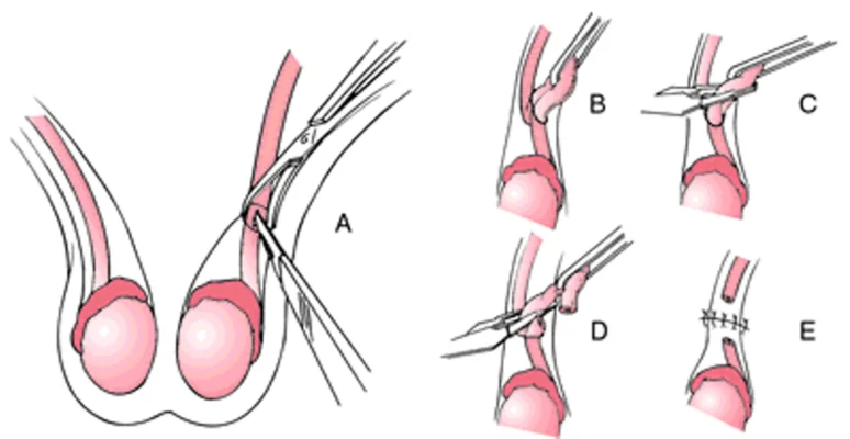 quy trình thắt ống dẫn tinh