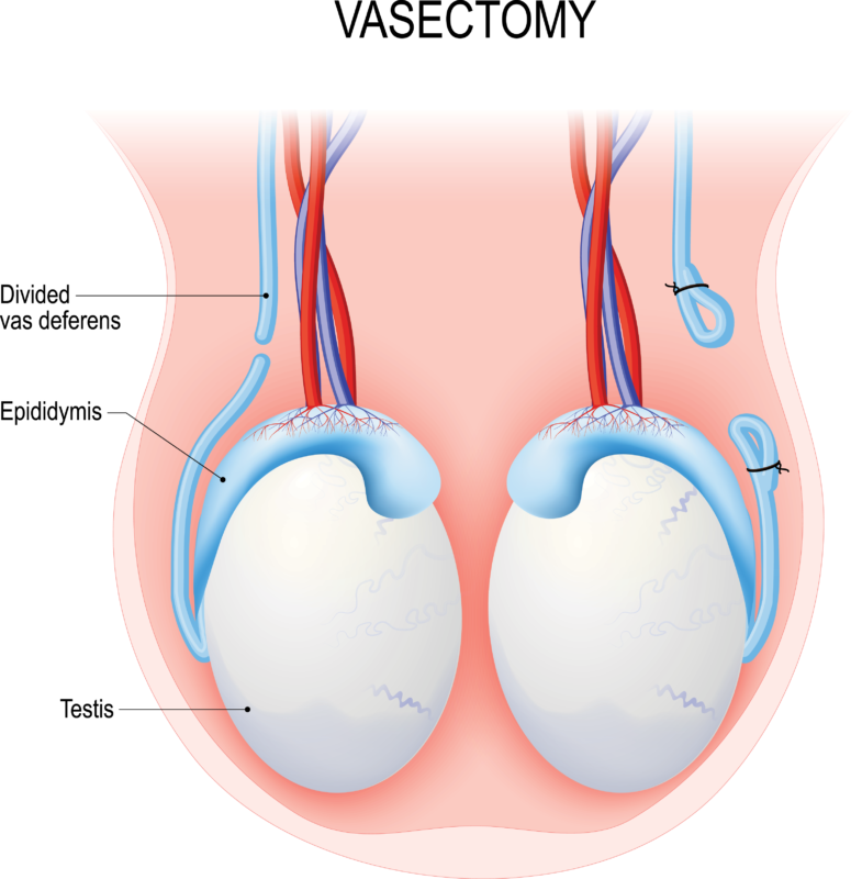 Thắt Ống Dẫn Tinh Có Ảnh Hưởng Gì Không? Thông Tin, Lợi Ích và Rủi Ro 4 sperm granuloma