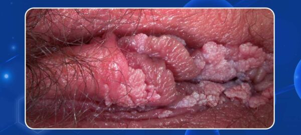 dấu hiệu sùi mào gà ở nữ