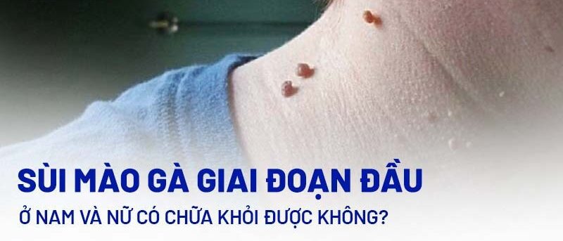 Giai đoạn đầu của sùi mào gà: Nguyên nhân, Dấu hiệu, Triệu chứng và Cách nhận biết 1 Giai đoạn đầu của sùi mào gà