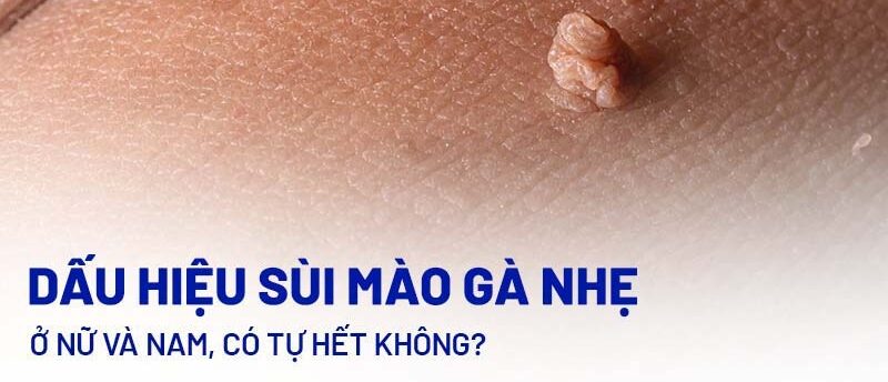 Sùi mào gà nhẹ có tự hết không? Thông tin, Yếu tố và Hướng điều trị 2 Nhận Diện Kẻ Thù