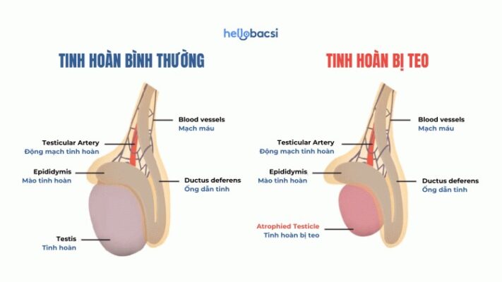 Teo tinh hoàn là gì