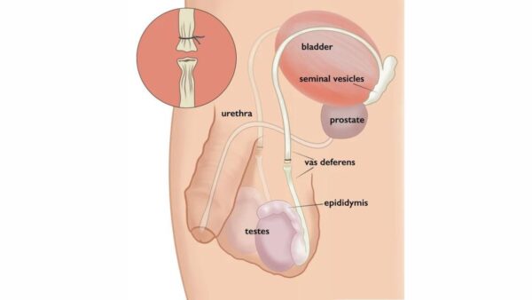 Thắt ống dẫn tinh có nối lại được không