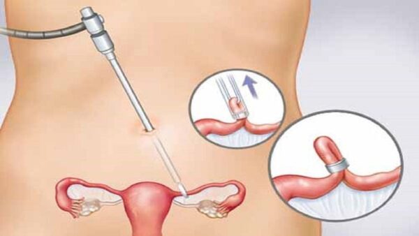 Thắt Ống Dẫn Trứng