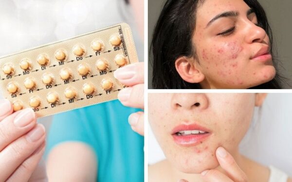 Loại Thuốc Tránh Thai Nào Trị Mụn Tốt Nhất