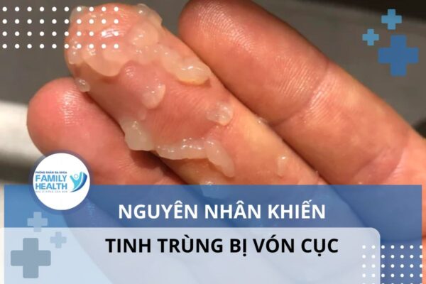 nguyên nhân tinh trùng vón cục