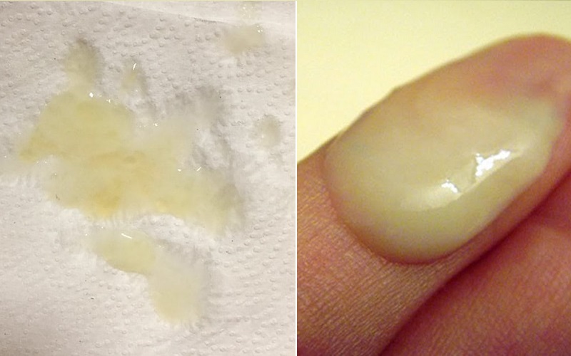 Tinh trùng vón cục màu vàng