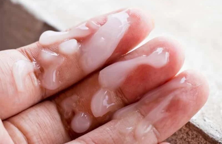 Tinh trùng vón cục như hạt gạo