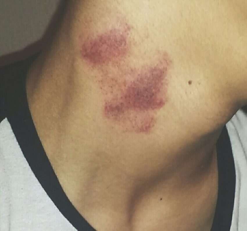 Bí Kíp “Xóa Sổ” Hickey Cấp Tốc