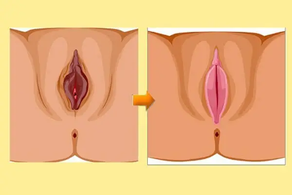 Trị Thâm Vùng Kín