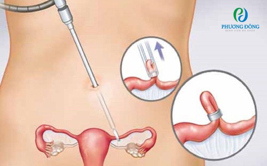 Thắt Ống Dẫn Trứng