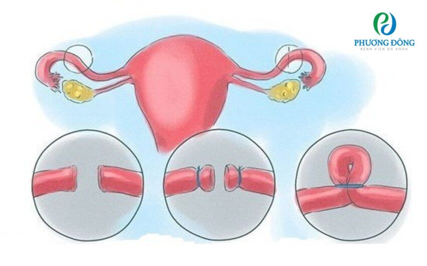 Đối với triệt sản nữ