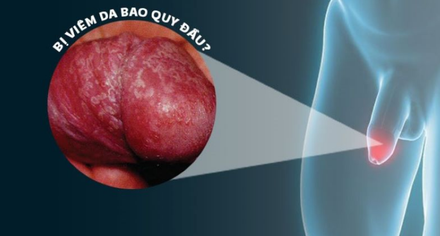 Thủ dâm chảy máu: Thông tin, Nguyên nhân, Mức độ nguy hiểm và Cách xử lý 2 Viêm bao quy đầu