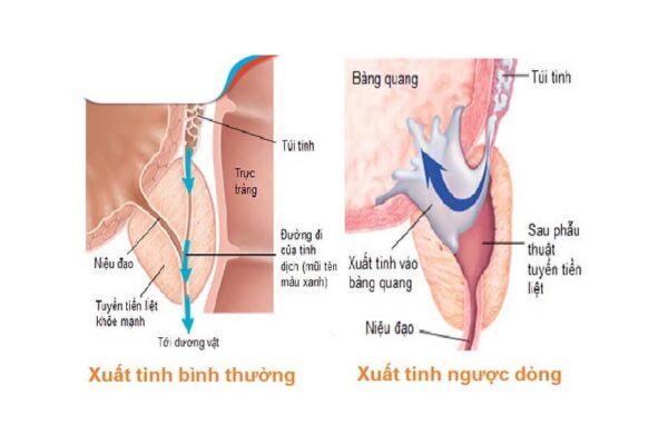 Xuất tinh ngược dòng: Thông tin, Nguyên nhân, Triệu chứng và Cách điều trị 70 Xuất tinh ngược dòng