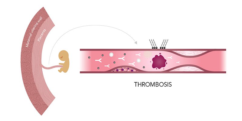 Thai lưu 7 tuần nên hút hay uống thuốc? Phân tích, So sánh, Chi phí và Quy trình xử lý 2 Antiphospholipid