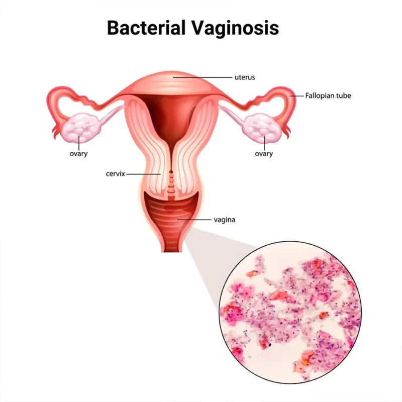 Bacterial Vaginosis - BV