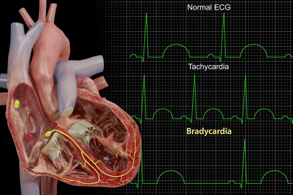 Mấy tuần có tim thai: Thông tin, Thời điểm, Ý nghĩa và Các mốc siêu âm 4 Bradycardia