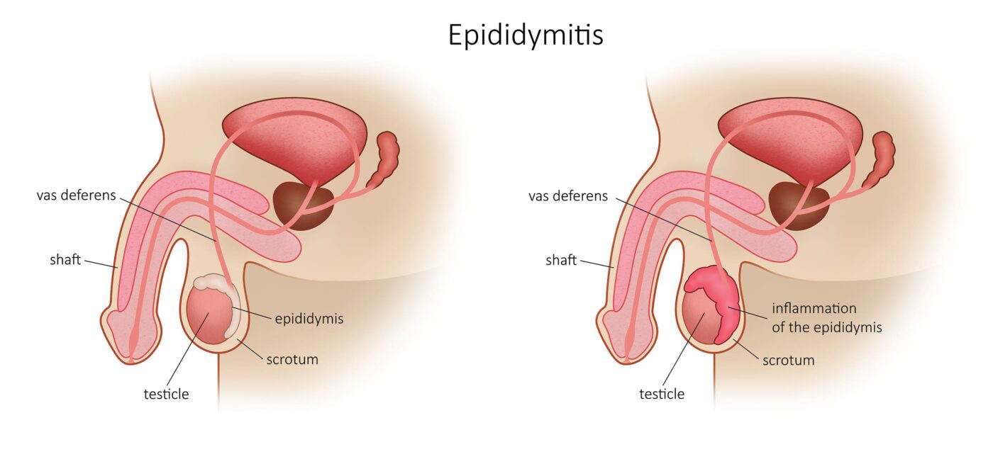 Epididymitis