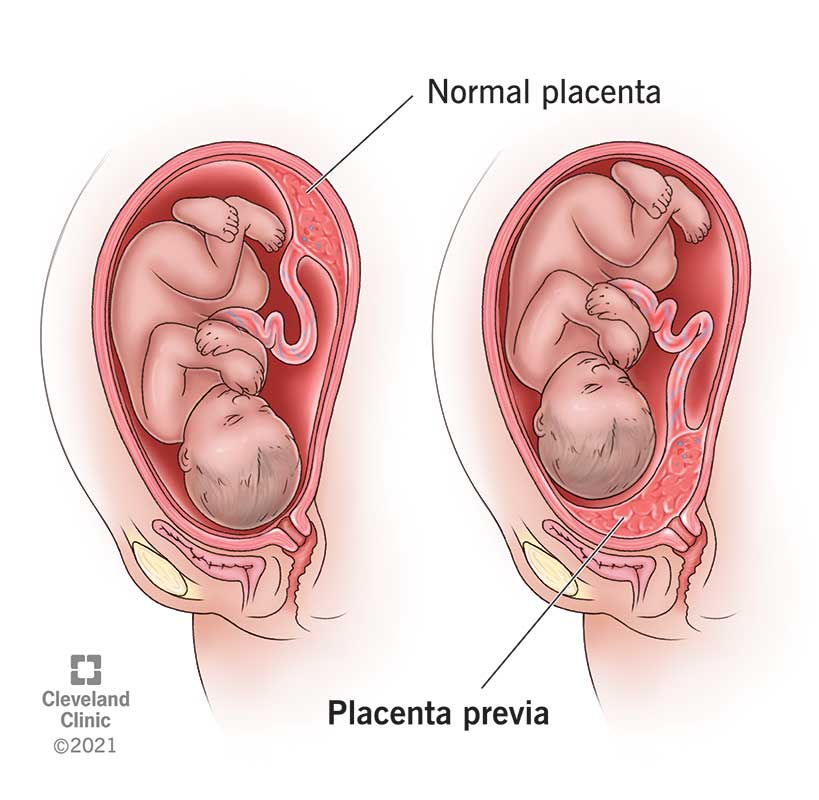 Placenta Previa