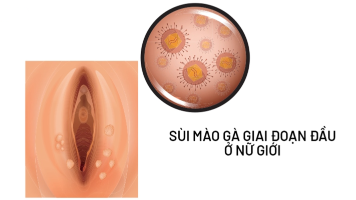 Virus HPV: Thông tin, Phân loại, Triệu chứng, Lây truyền, Chẩn đoán và Phòng ngừa 8 sùi mào gà ở nữ