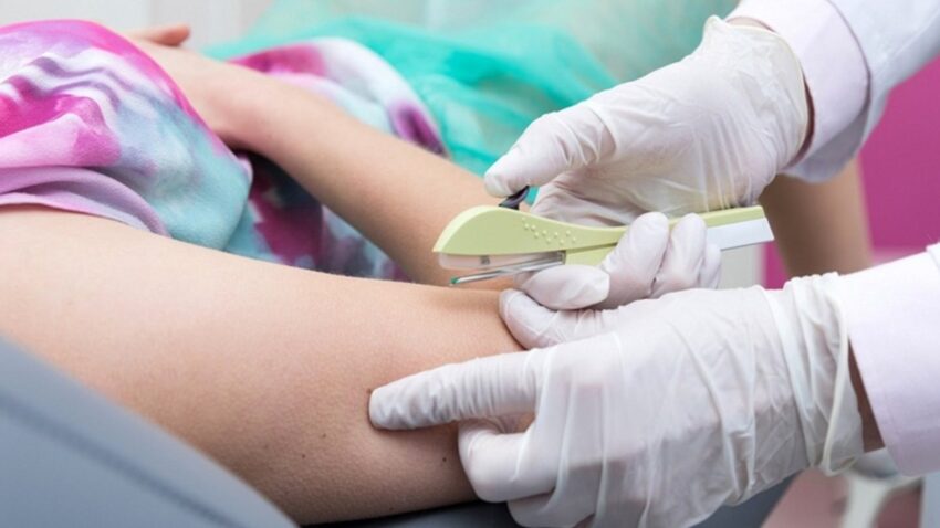 tháo que tránh thai có giảm cân không