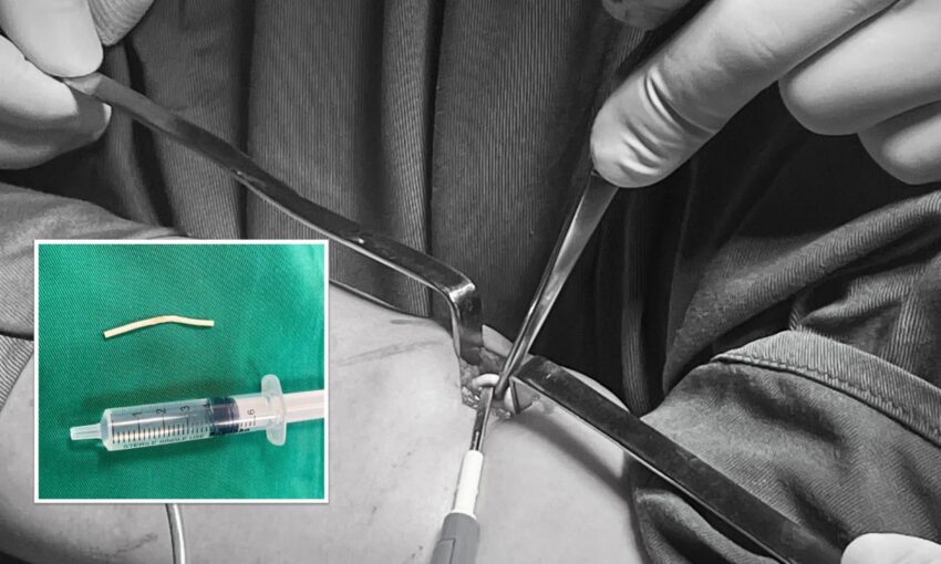 Tác dụng phụ của cấy que tránh thai
