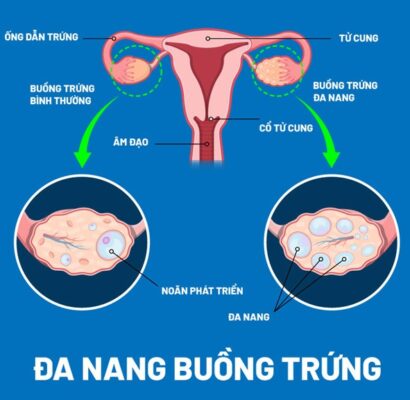 Cách khắc phục niêm mạc tử cung dày: Nguyên nhân, Dấu hiệu, Chẩn đoán và Phương pháp điều trị 3 Buồng trứng đa nang
