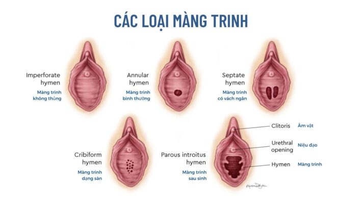 Các Loại Màng Trinh