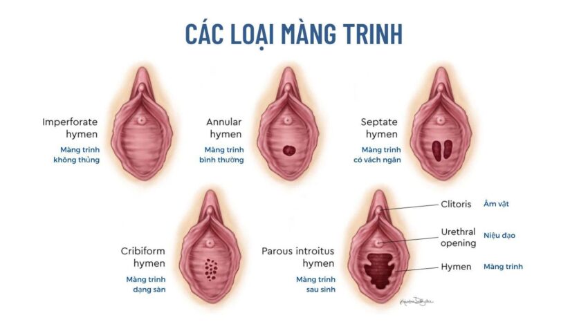 Các Loại Màng Trinh