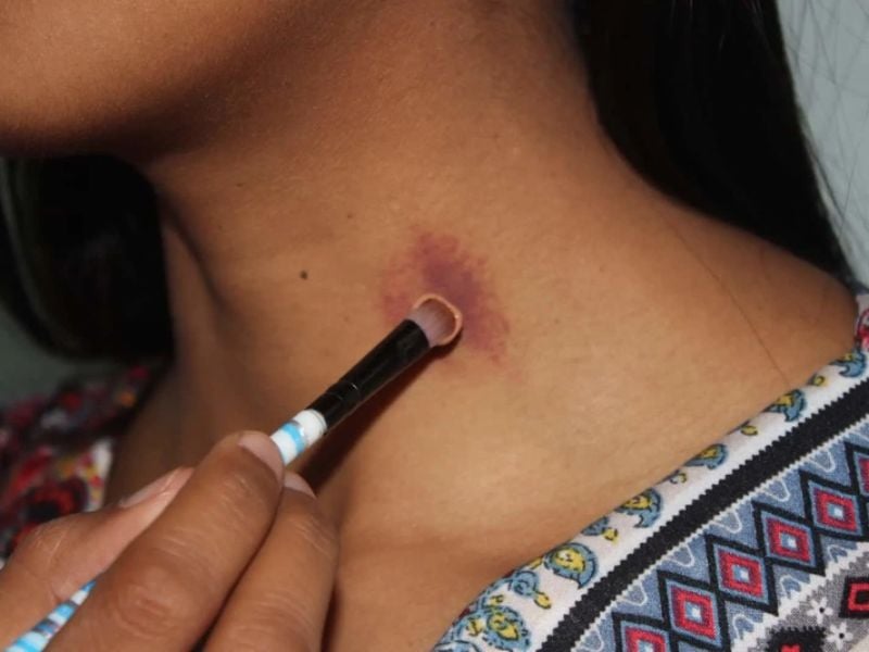 che vết hickey