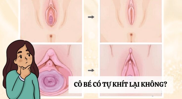 cô bé có tự khít lại không