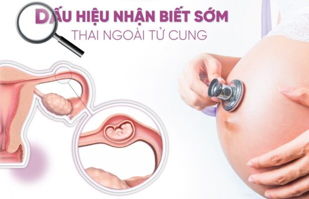 Biểu hiện thai ngoài tử cung