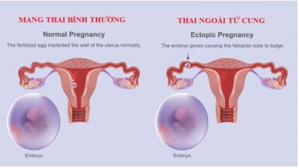 Những Biểu Hiện Thai Ngoài Tử Cung Dễ Bị Lầm Tưởng Nhất