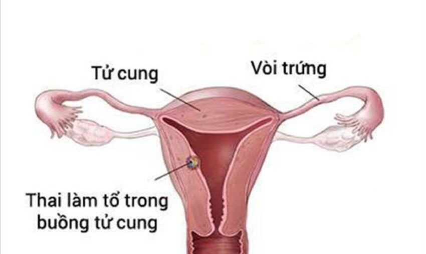 Bao lâu thì thai vào tử cung