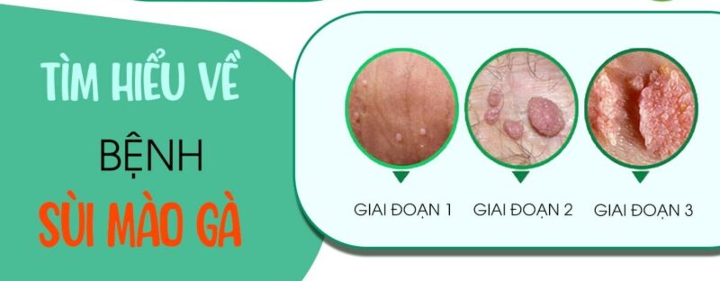 Bệnh sùi mào gà có nguy hiểm không