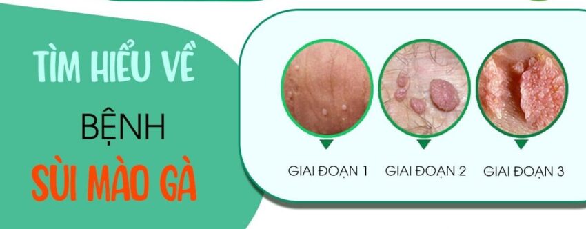Bệnh sùi mào gà có nguy hiểm không