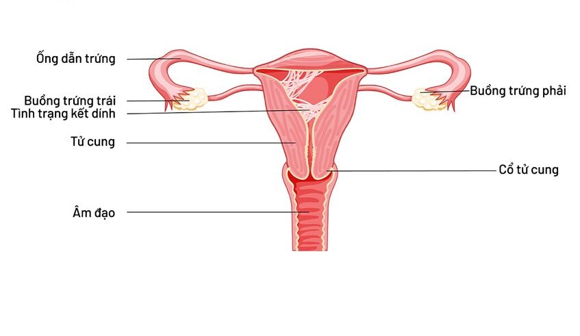 Mức Độ Dính Buồng Tử Cung