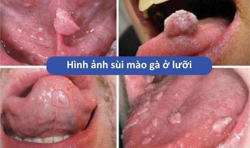 Tiêm vắc-xin