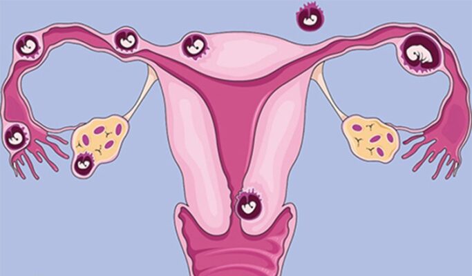 Thai Ngoài Tử Cung Có Biểu Hiện Gì? Thông Tin Chi Tiết Về Dấu Hiệu, Nguyên Nhân và Cách Xử Lý 75 Thai ngoài tử cung là gì