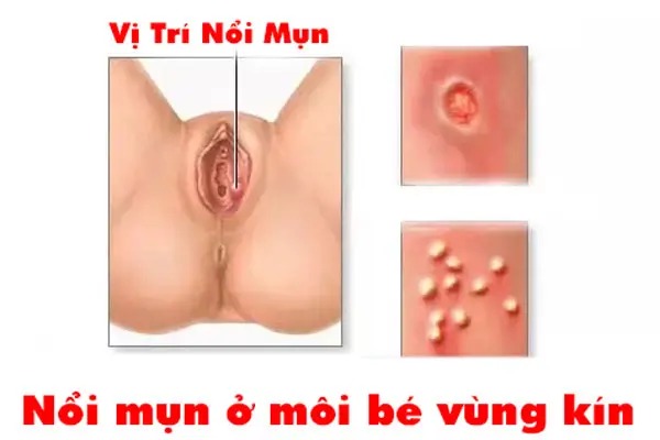 mụn ở môi bé vùng kín