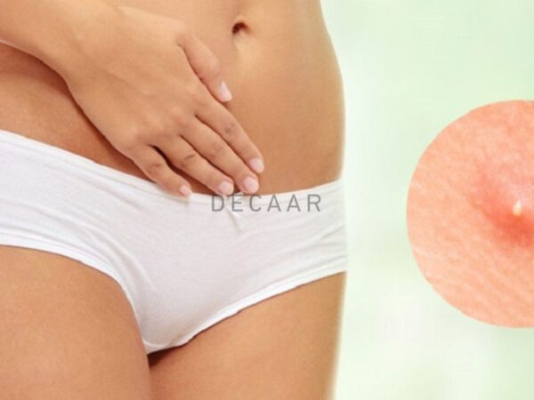 Mụn trứng cá ở vùng kín