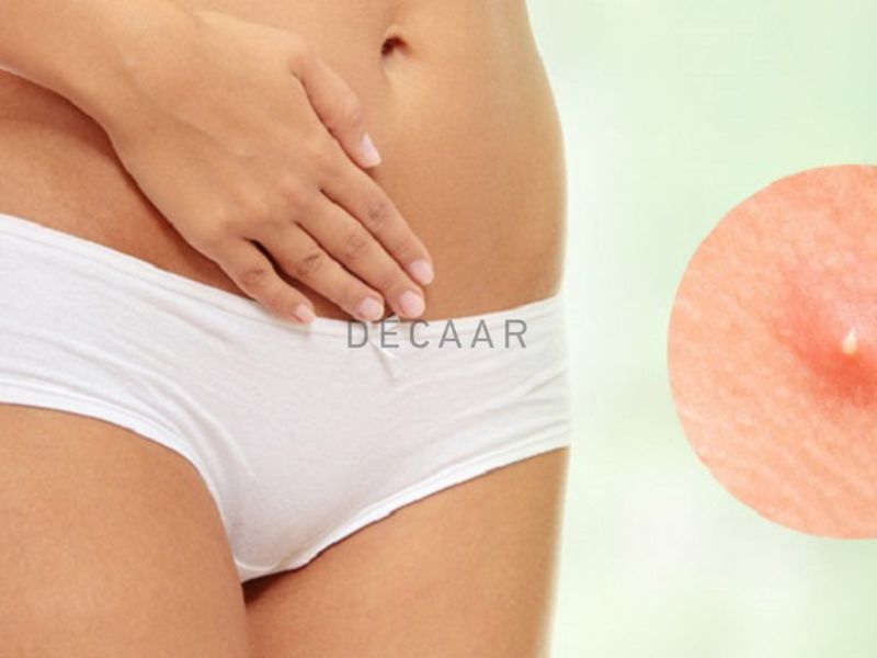 Cách Tỉa Lông Vùng Kín Nữ Tại Nhà: Lợi Ích, Công Cụ, Phương Pháp và Chăm Sóc An Toàn 5 Mụn trứng cá ở vùng kín