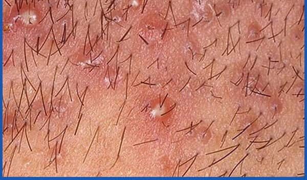 Mụn Trứng Cá Ở Vùng Kín